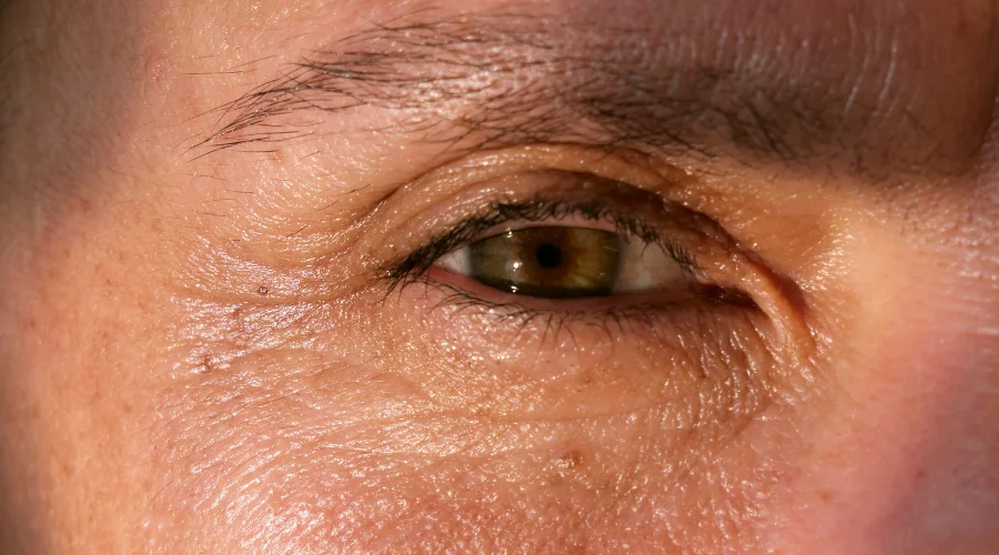 Göz Çevresi Kırışıklıkları İçin Tedavi Seçenekleri